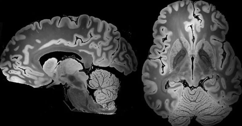Neuroscienze strumento di umanizzazione della giustizia e non prova di innocenza del singolo